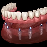 Digital image of an implant denture