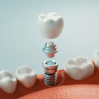 Up-close view of dental implant parts