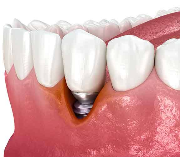 Digital image of peri-implantitis