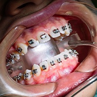 Up-close view of brackets being placed on patient’s teeth